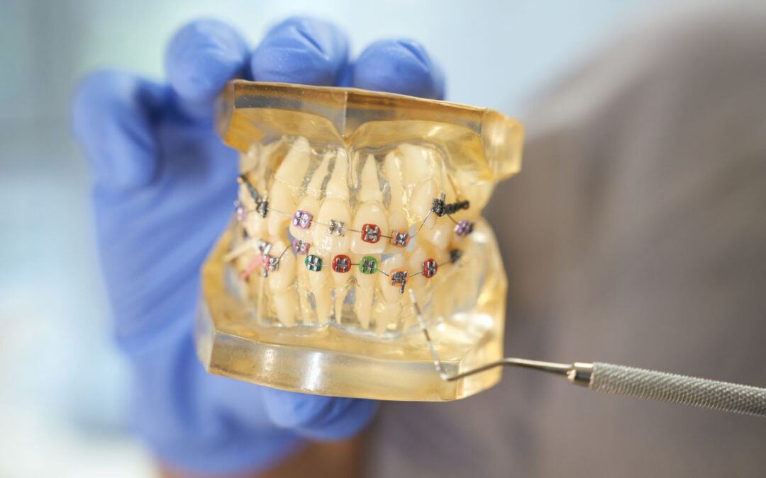Dental model displaying colorful self-ligating braces on teeth with orthodontic wire.