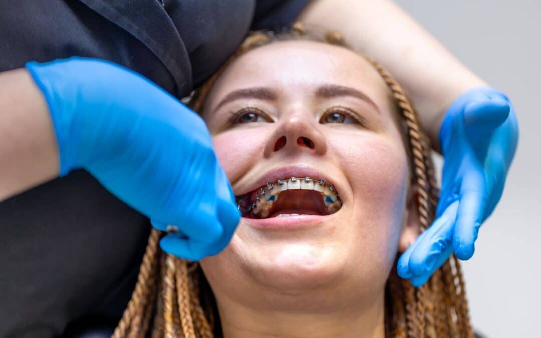 Straighten Teeth with Braces