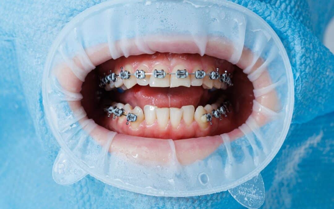 clear aligners vs braces