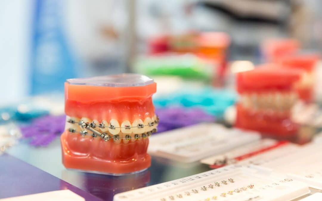 Dental model with metal braces displaying orthodontic treatment options for patients in San Antonio.