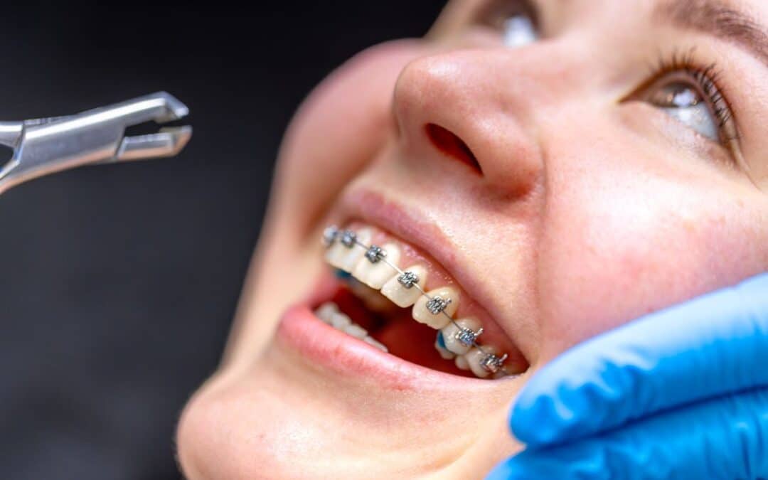 How Do Braces Work? A Beginner’s Guide to Straightening Teeth